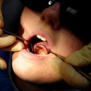 There were around 55 hospital admissions in Stevenage for children's tooth extraction in the year to March 2023.